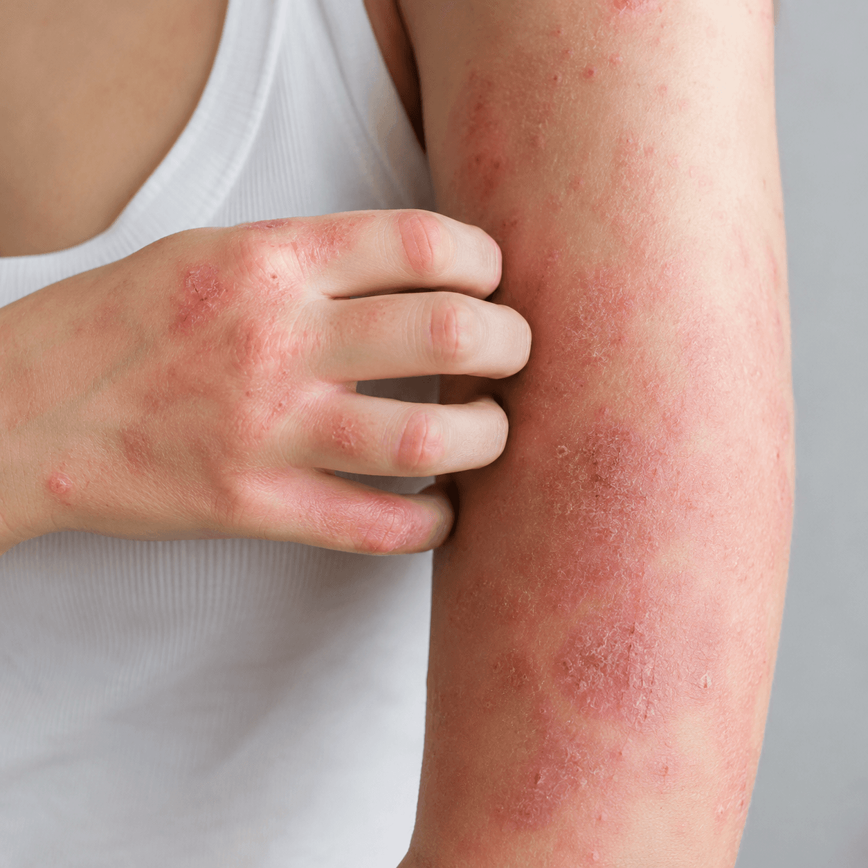 Dermatitis atópica